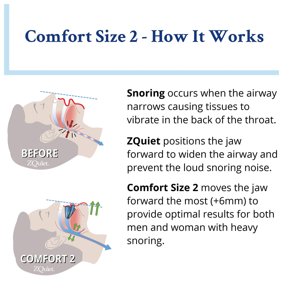 Anti-Snoring Mouthpiece Y36098